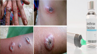 অ্যানথ্রাক্স প্রতিরোধে রংপুরে ৩০ লাখ টিকা প্রয়োগের প্রস্তুতি শুরু অ্যানথ্রাক্স প্রতিরোধে রংপুরে ৩০ লাখ টিকা প্রয়োগের প্রস্তুতি শুরু