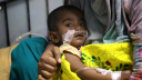 হামের প্রাদুর্ভাব: ২৪ ঘণ্টায় ৪ জনের মৃত্যু