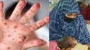 হামের উপসর্গে ২৪ ঘণ্টায় আরও ৬ শিশুর মৃত্যু
