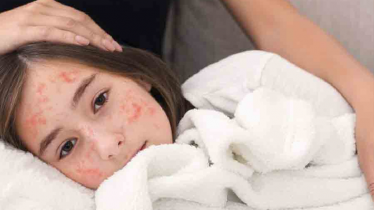 হাম সংক্রমণ এড়াতে ঘরে ও বাইরে যা করণীয়