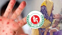 হামের উপসর্গে আরও ৭ শিশুর মৃত্যু
