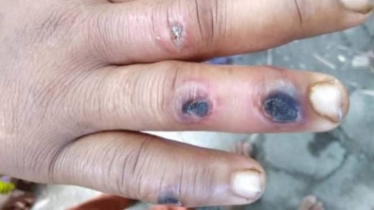 ১১ জনের শরীরে অ্যানথ্রাক্স উপসর্গ