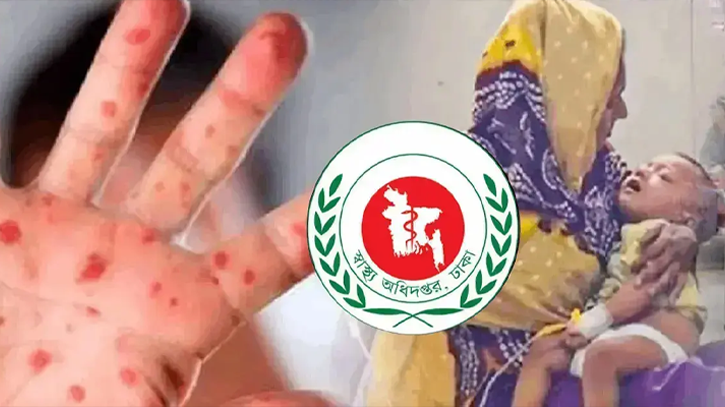 ২৪ ঘণ্টায় হাম উপসর্গে ৫ জনের মৃত্যু, নতুন রোগী ৭৯৬