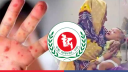 হামের উপসর্গ নিয়ে আরও ৭ শিশুর মৃত্যু