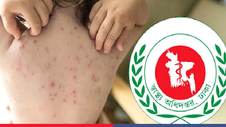 Measles symptoms claim four more lives